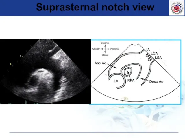 Suprasternal notch view