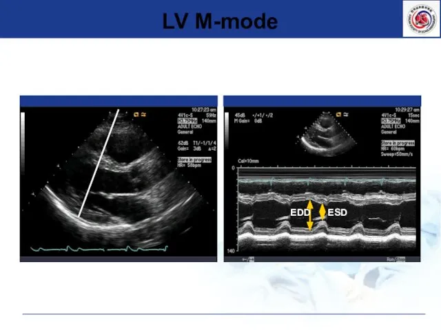 LV M-mode EDD ESD