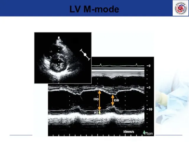 LV M-mode