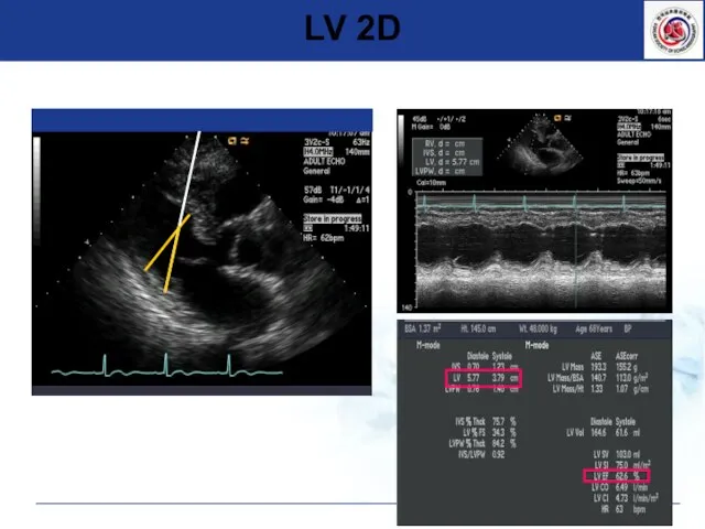 Oblique parasternal images를 피한다. LV 2D