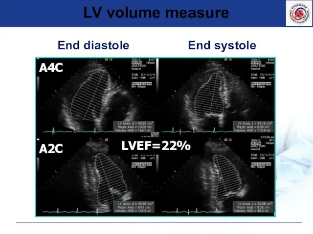 LV volume measure End diastole End systole A2C A4C LVEF=22%