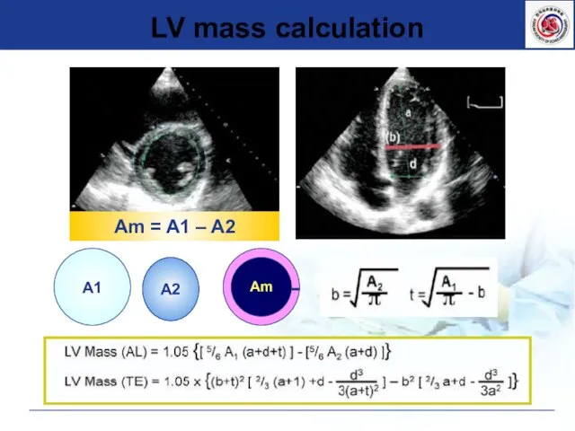 LV mass calculation A2 A1 Am Am = A1 – A2