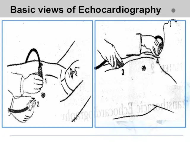 Basic views of Echocardiography Apical view Subcostal view Suprasternal view