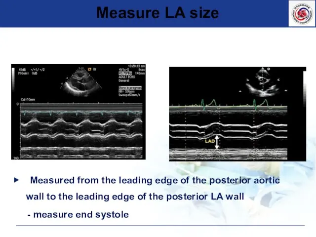 ▶ Measured from the leading edge of the posterior aortic wall to