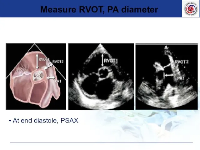 At end diastole, PSAX Measure RVOT, PA diameter