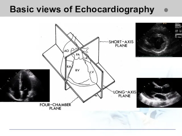 Basic views of Echocardiography
