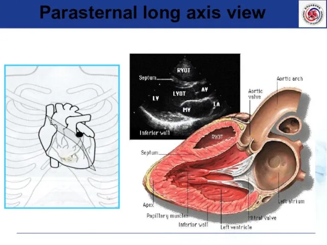 Parasternal long axis view