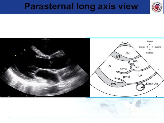 Parasternal long axis view