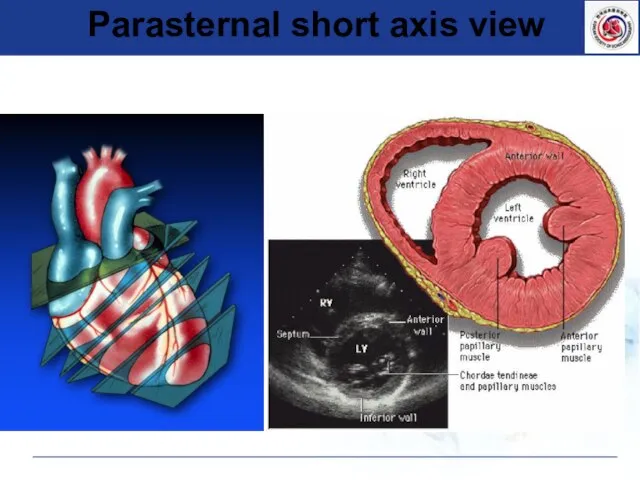 Parasternal short axis view