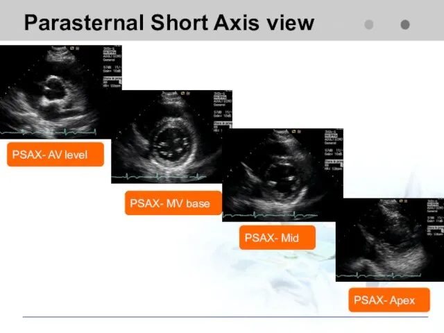 Parasternal Short Axis view PSAX- AV level PSAX- Mid PSAX- MV base PSAX- Apex
