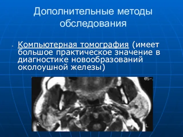 Дополнительные методы обследования Компьютерная томография (имеет большое практическое значение в диагностике новообразований околоушной железы)