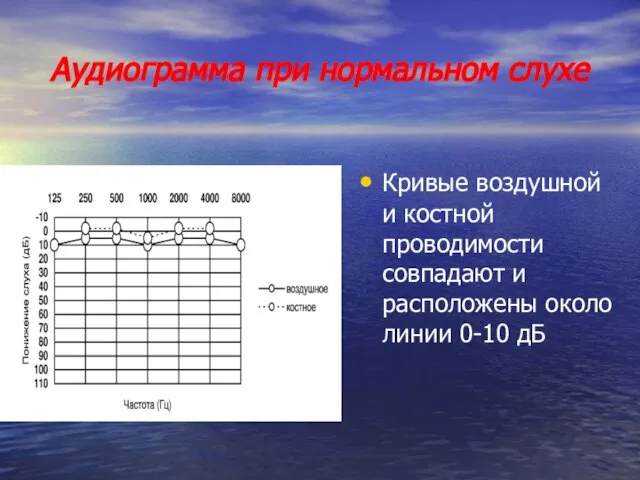 Аудиограмма при нормальном слухе Кривые воздушной и костной проводимости совпадают и расположены около линии 0-10 дБ