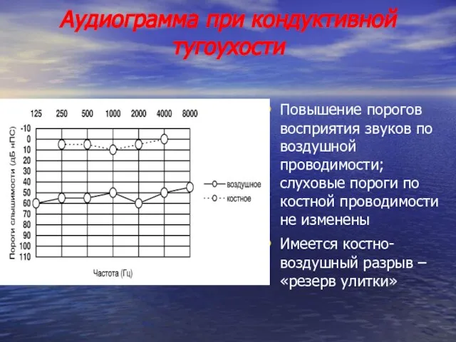 Аудиограмма при кондуктивной тугоухости Повышение порогов восприятия звуков по воздушной проводимости; слуховые