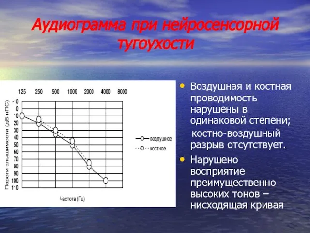 Аудиограмма при нейросенсорной тугоухости Воздушная и костная проводимость нарушены в одинаковой степени;