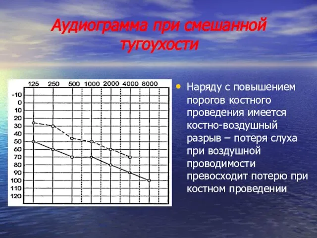 Аудиограмма при смешанной тугоухости Наряду с повышением порогов костного проведения имеется костно-воздушный