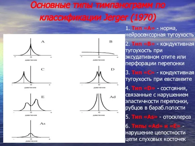 Основные типы тимпанограмм по классификации Jerger (1970) 1. Тип «А» - норма,