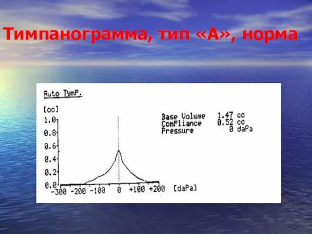 Тимпанограмма, тип «А», норма
