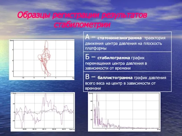 Образцы регистрации результатов стабилометрии