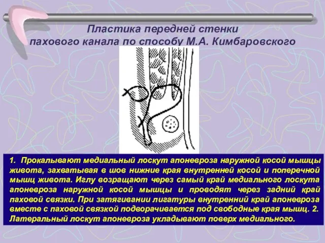 Пластика передней стенки пахового канала по способу М.А. Кимбаровского 1. Прокалывают медиальный