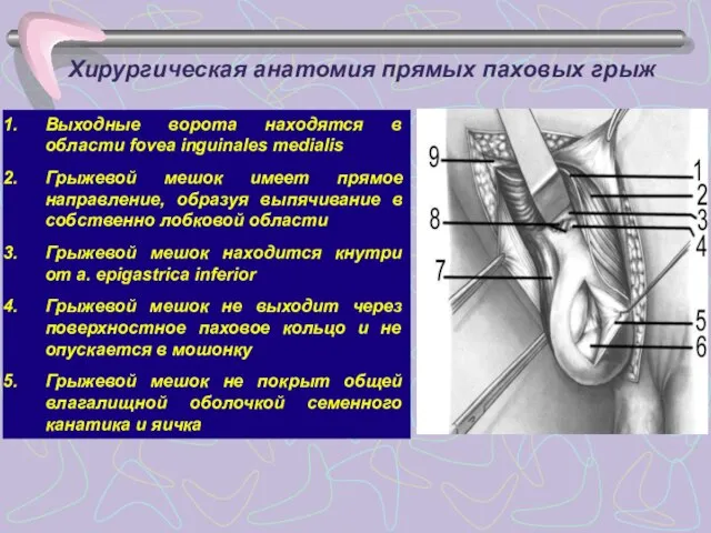 Хирургическая анатомия прямых паховых грыж Выходные ворота находятся в области fovea inguinales