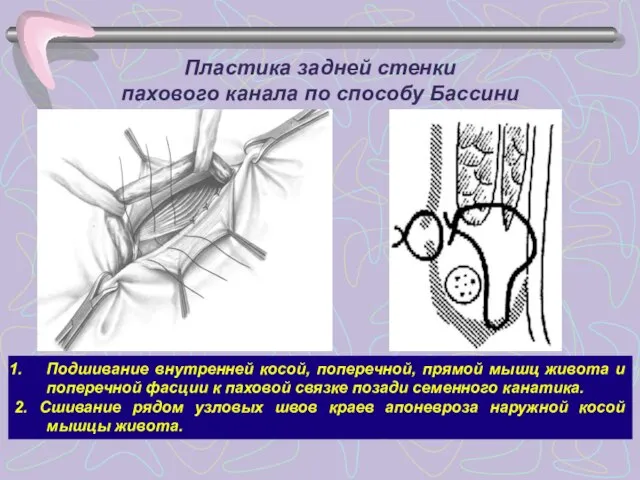 Пластика задней стенки пахового канала по способу Бассини Подшивание внутренней косой, поперечной,