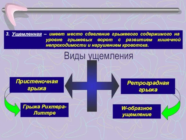 Пристеночная грыжа Ретроградная грыжа Грыжа Рихтера-Литтре W-образное ущемление 3. Ущемленная – имеет