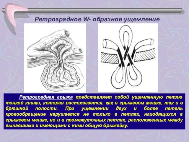 Ретроградное W- образное ущемление Ретроградная грыжа представляет собой ущемленную петлю тонкой кишки,