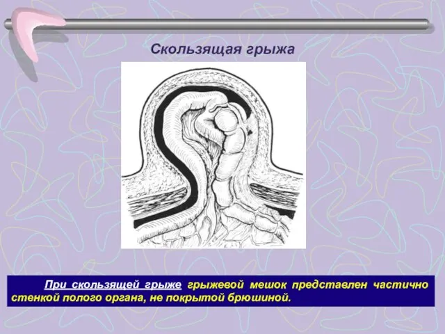 Скользящая грыжа При скользящей грыже грыжевой мешок представлен частично стенкой полого органа, не покрытой брюшиной.