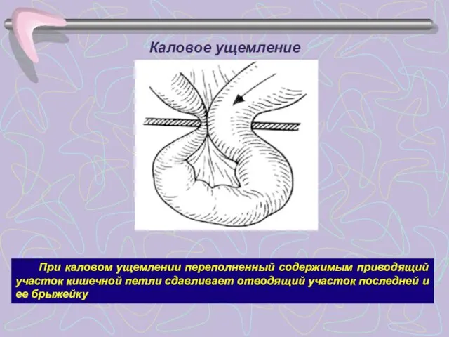 Каловое ущемление При каловом ущемлении переполненный содержимым приводящий участок кишечной петли сдавливает