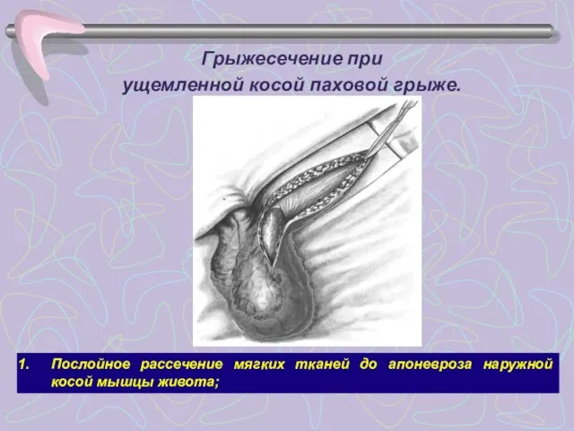 Грыжесечение при ущемленной косой паховой грыже. Послойное рассечение мягких тканей до апоневроза наружной косой мышцы живота;