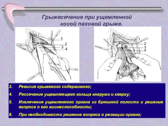 Грыжесечение при ущемленной косой паховой грыже. Ревизия грыжевого содержимого; Рассечение ущемляющего кольца