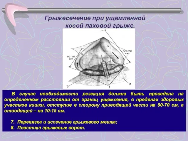 Грыжесечение при ущемленной косой паховой грыже. В случае необходимости резекция должна быть