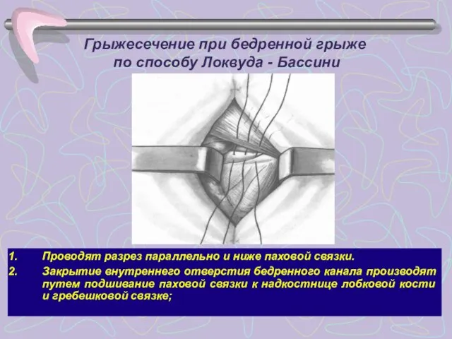 Грыжесечение при бедренной грыже по способу Локвуда - Бассини Проводят разрез параллельно