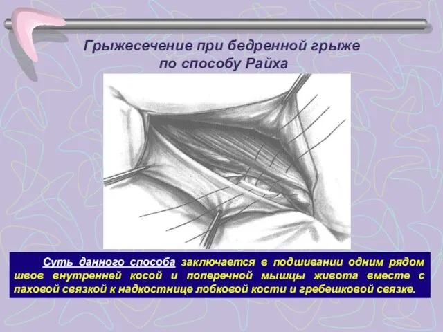 Грыжесечение при бедренной грыже по способу Райха Суть данного способа заключается в