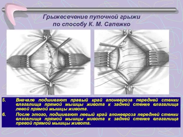 Грыжесечение пупочной грыжи по способу К. М. Сапежко Вначале подшивают правый край