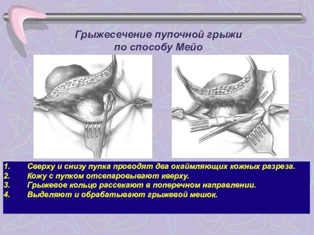 Грыжесечение пупочной грыжи по способу Мейо Сверху и снизу пупка проводят два