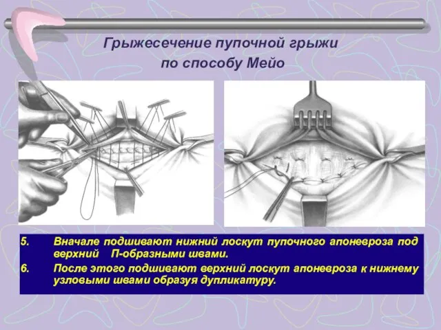 Грыжесечение пупочной грыжи по способу Мейо Вначале подшивают нижний лоскут пупочного апоневроза