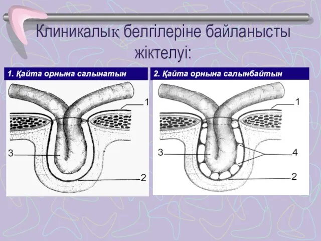 1. Қайта орнына салынатын 2. Қайта орнына салынбайтын Клиникалық белгілеріне байланысты жіктелуі: