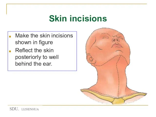 Skin incisions Make the skin incisions shown in figure Reflect the skin