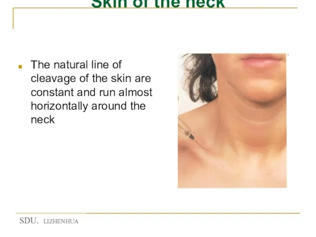 Skin of the neck The natural line of cleavage of the skin