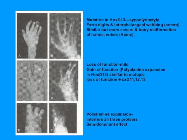 Mutation in HoxD13—synpolydactyly Extra digits & interphalangeal webbing (hetero) Similar but more
