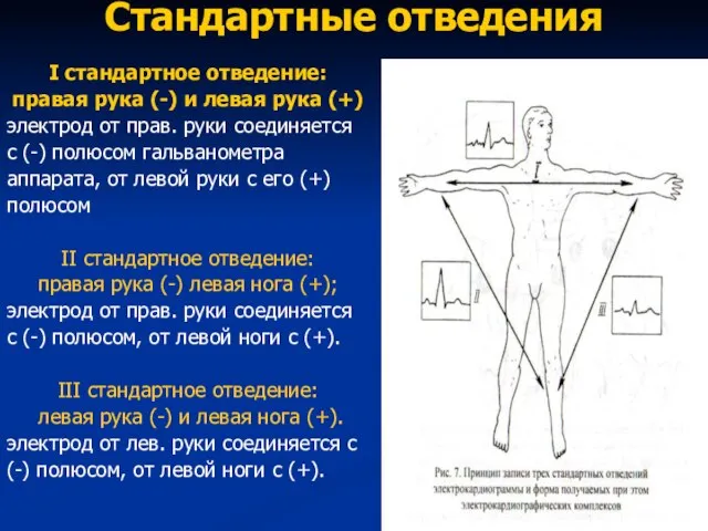 Стандартные отведения I стандартное отведение: правая рука (-) и левая рука (+)