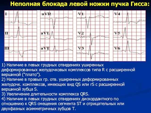 Неполная блокада левой ножки пучка Гисса: 1) Наличие в левых грудных отведениях