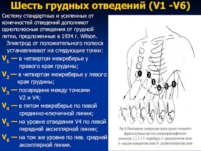 Шесть грудных отведений (V1 -V6) Систему стандартных и усиленных от конечностей отведений