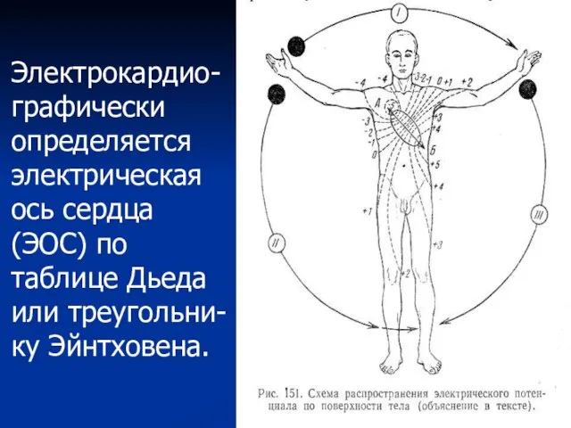 Электрокардио-графически определяется электрическая ось сердца (ЭОС) по таблице Дьеда или треугольни-ку Эйнтховена.