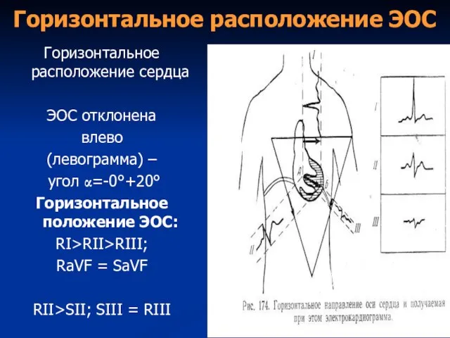 Горизонтальное расположение ЭОС Горизонтальное расположение сердца ЭОС отклонена влево (левограмма) – угол