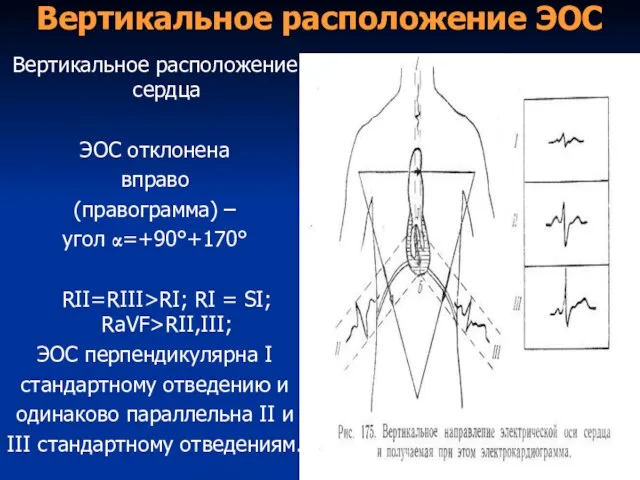 Вертикальное расположение ЭОС Вертикальное расположение сердца ЭОС отклонена вправо (правограмма) – угол