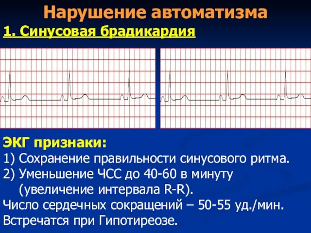 Нарушение автоматизма 1. Синусовая брадикардия ЭКГ признаки: 1) Сохранение правильности синусового ритма.