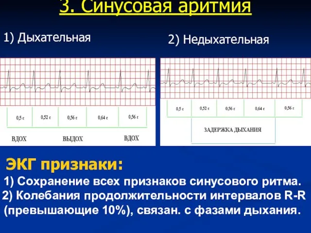 3. Синусовая аритмия 1) Дыхательная ЭКГ признаки: 1) Сохранение всех признаков синусового