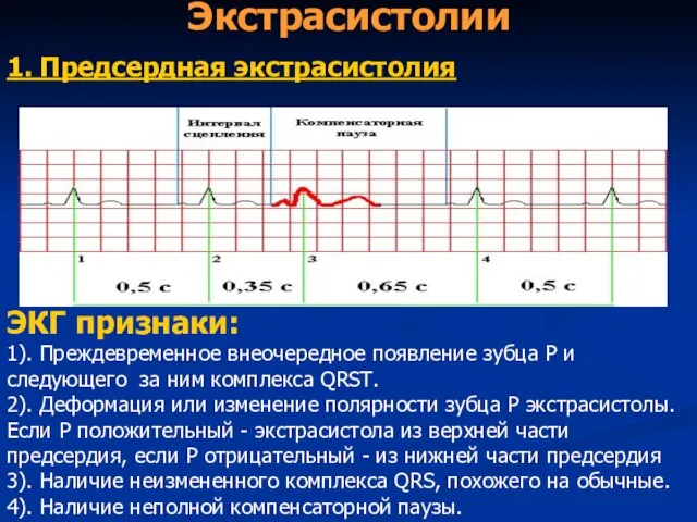 Экстрасистолии 1. Предсердная экстрасистолия ЭКГ признаки: 1). Преждевременное внеочередное появление зубца Р